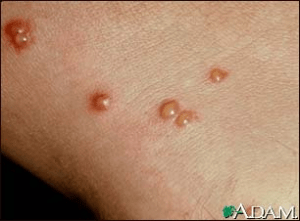 Chigger bite blisters MedlinePlus