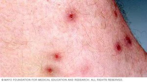 Scabbed chigger bites Mayo Clinic 